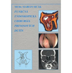 Funkčná endoskopická chirurgia prinosových dutín - Marián Sičák